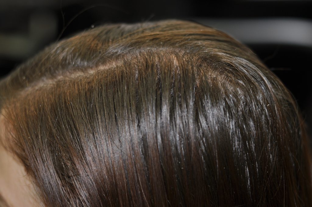 Oily scalp with slight dandruff, resulting in thinning hair 
