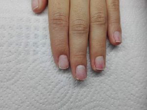 Thin and sensitive nails after shellac removal