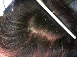 Flaky scalp? This treatment is a revelation | Figaro London
