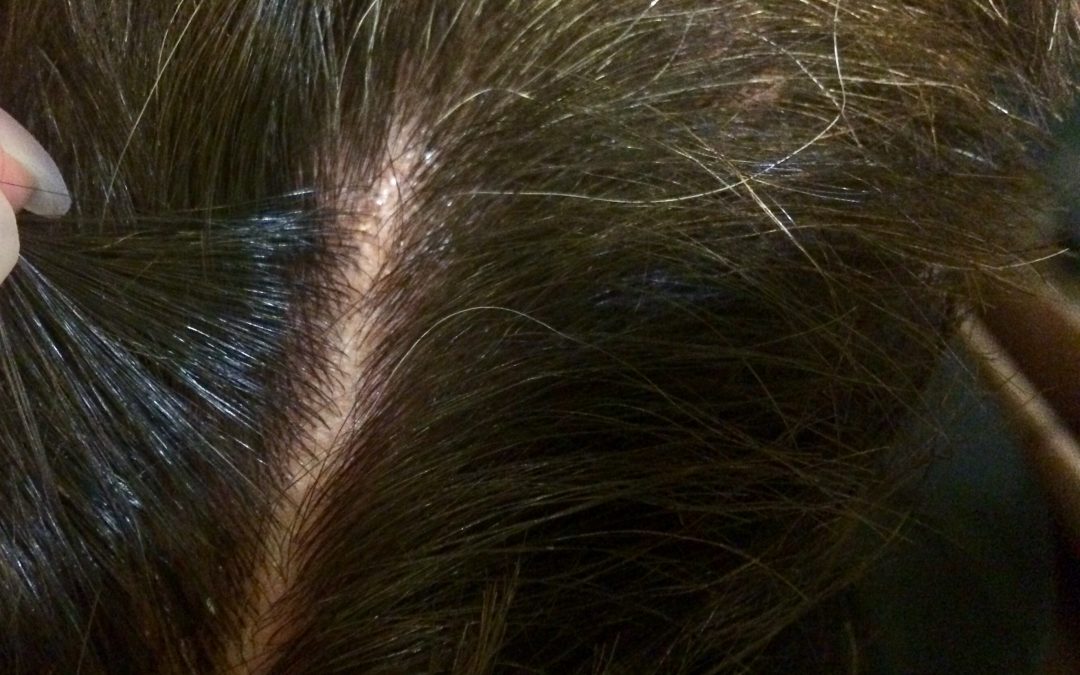 Flaky scalp? This treatment is a revelation